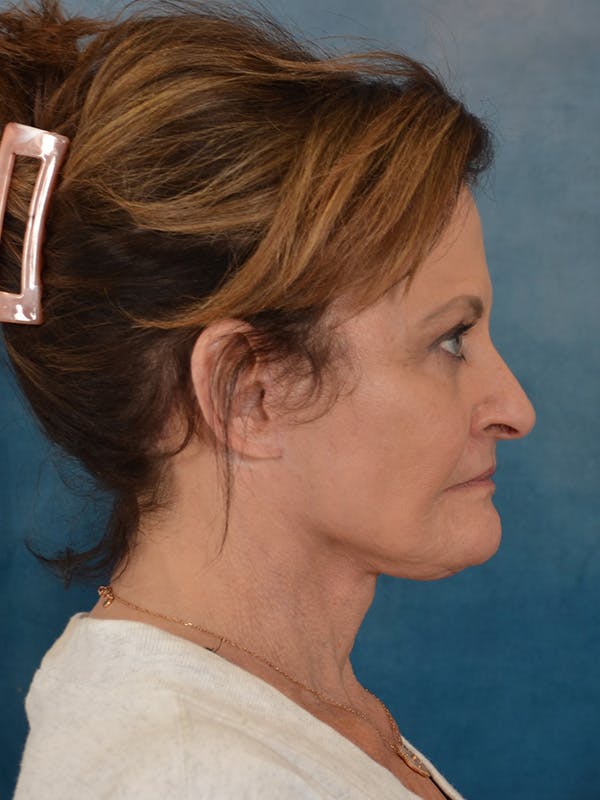 Deep Neck Lift Before & After Gallery - Patient 966989 - Image 6