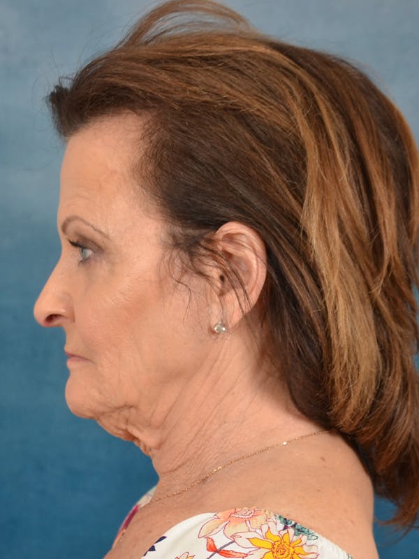 Deep Neck Lift Before & After Gallery - Patient 966989 - Image 9