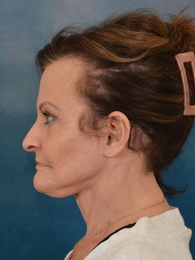 Deep Neck Lift Before & After Gallery - Patient 966989 - Image 10