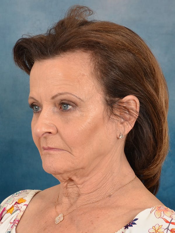 Deep Neck Lift Before & After Gallery - Patient 966989 - Image 7