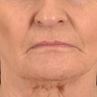 Lip Lift Before & After Gallery - Patient 153426 - Image 1