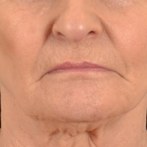 Lip Lift Before & After Gallery - Patient 153426 - Image 1
