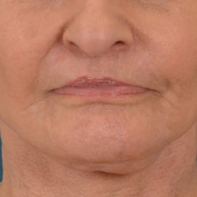 Lip Lift Before & After Gallery - Patient 153426 - Image 2