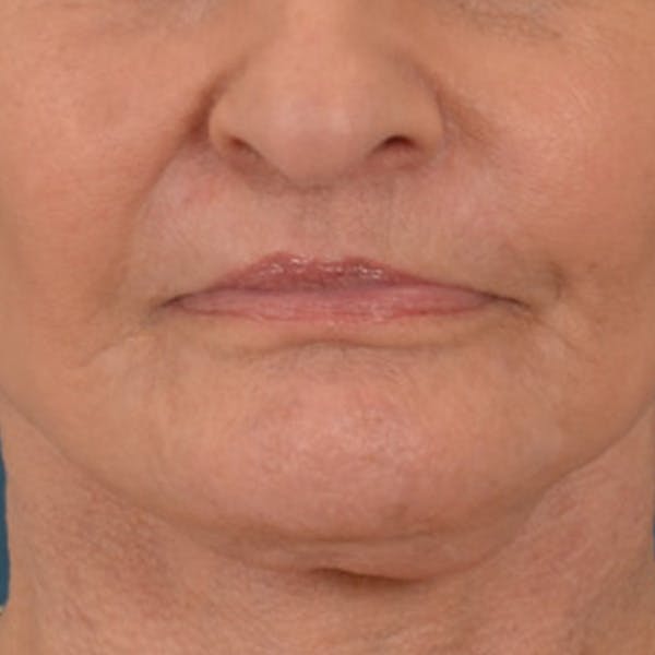 Lip Lift Before & After Gallery - Patient 153426 - Image 2