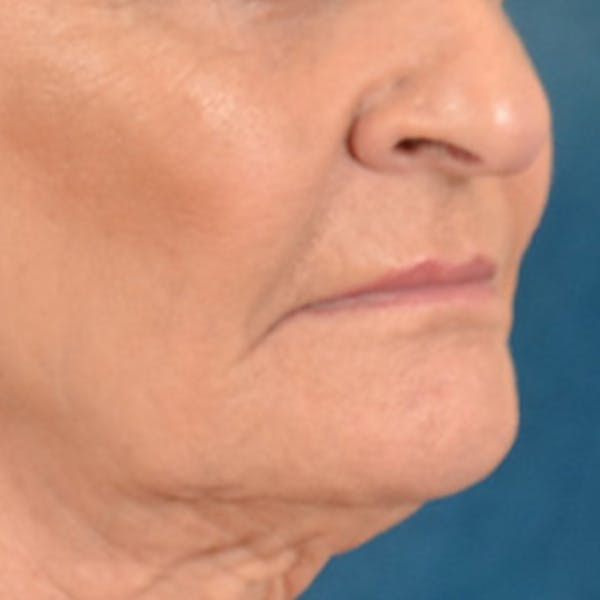 Lip Lift Before & After Gallery - Patient 153426 - Image 3