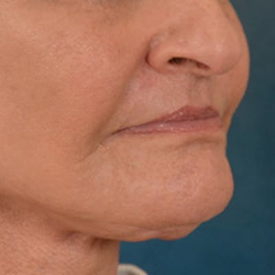 Lip Lift Before & After Gallery - Patient 153426 - Image 4