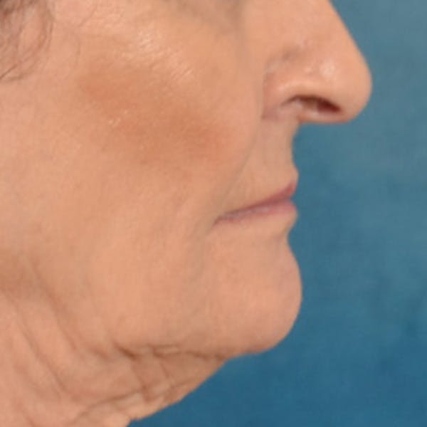 Lip Lift Before & After Gallery - Patient 153426 - Image 5