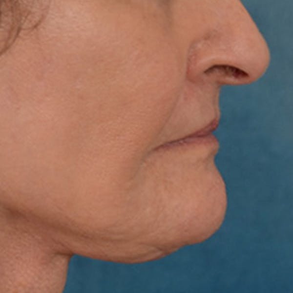 Lip Lift Before & After Gallery - Patient 153426 - Image 6