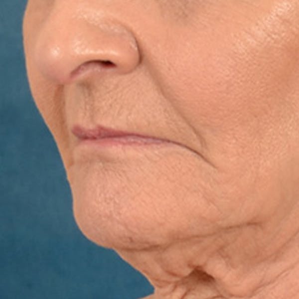 Lip Lift Before & After Gallery - Patient 153426 - Image 7