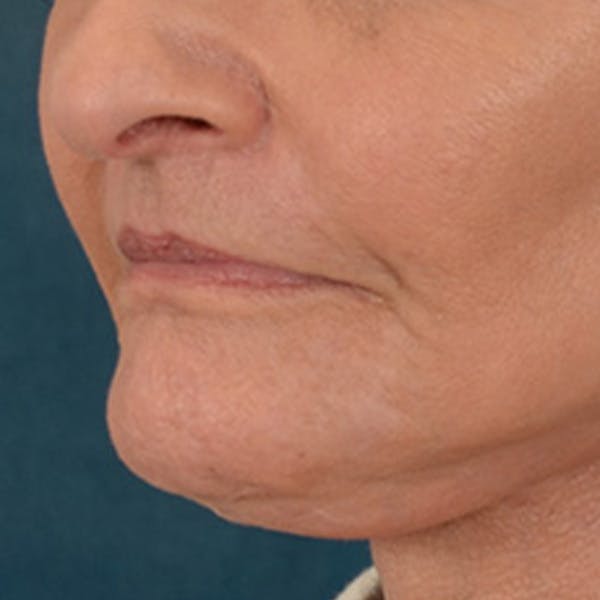 Lip Lift Before & After Gallery - Patient 153426 - Image 8