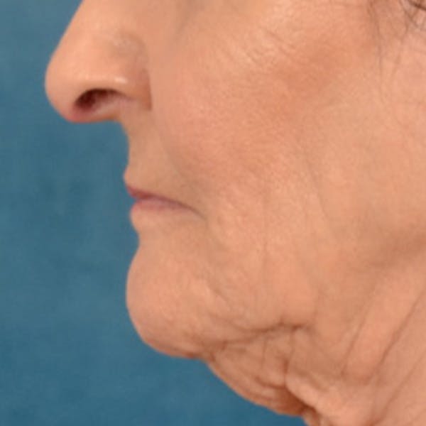 Lip Lift Before & After Gallery - Patient 153426 - Image 9