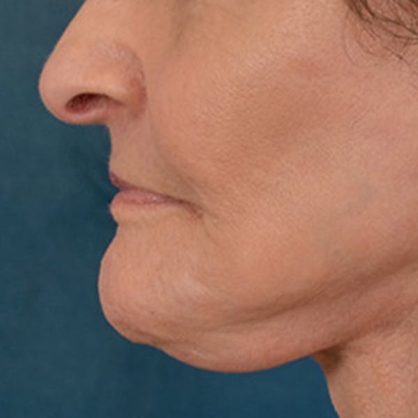 Lip Lift Before & After Gallery - Patient 153426 - Image 10