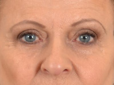 Eyelid Lift Before & After Gallery - Patient 123798 - Image 1