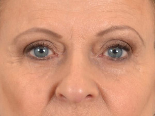 Eyelid Lift Before & After Gallery - Patient 123798 - Image 1