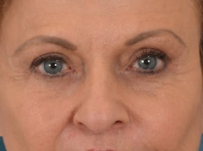Eyelid Lift Before & After Gallery - Patient 123798 - Image 2
