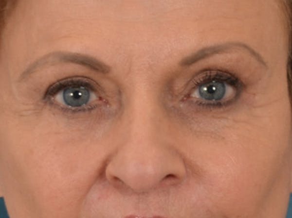 Eyelid Lift Before & After Gallery - Patient 123798 - Image 2