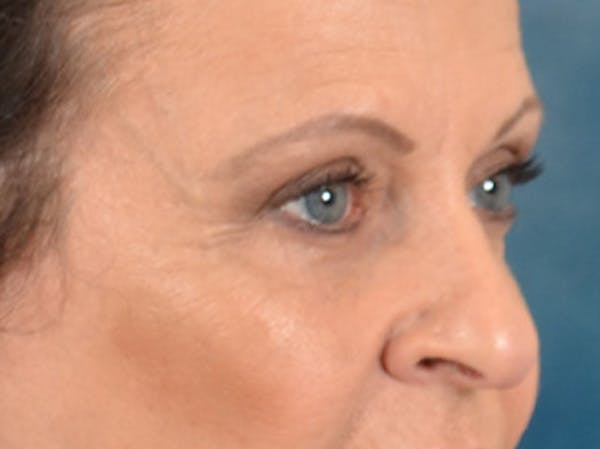 Eyelid Lift Before & After Gallery - Patient 123798 - Image 3