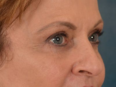 Eyelid Lift Before & After Gallery - Patient 123798 - Image 4