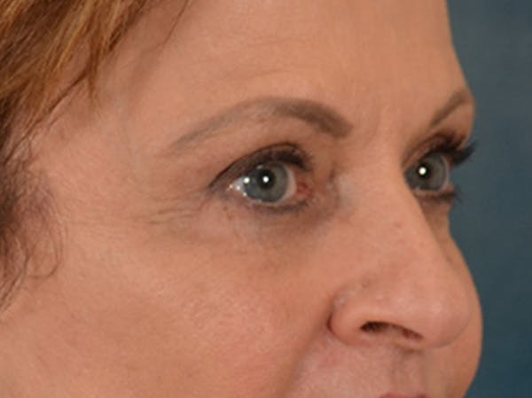 Eyelid Lift Before & After Gallery - Patient 123798 - Image 4