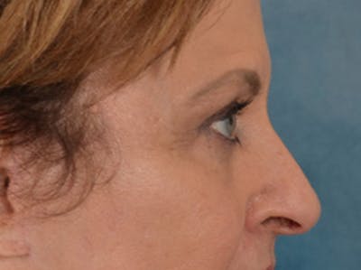 Eyelid Lift Before & After Gallery - Patient 123798 - Image 6