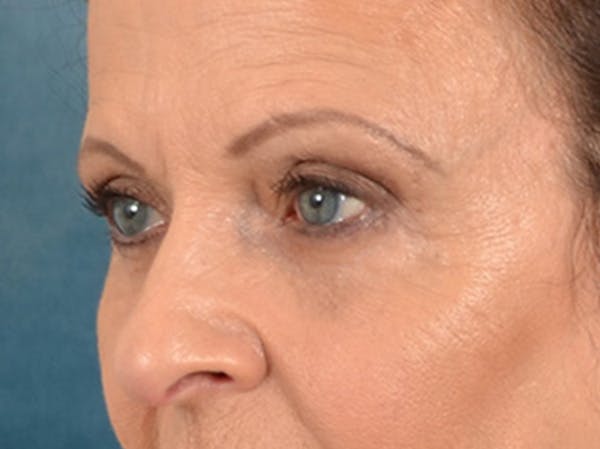 Eyelid Lift Before & After Gallery - Patient 123798 - Image 7