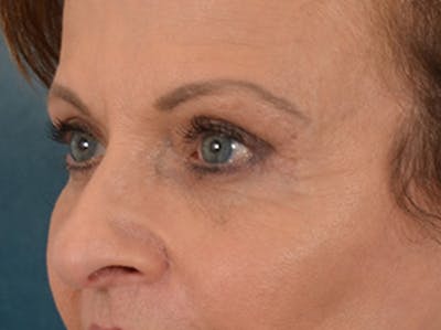 Eyelid Lift Before & After Gallery - Patient 123798 - Image 8