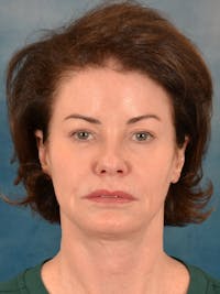 Fat Transfer Before & After Gallery - Patient 331625 - Image 1