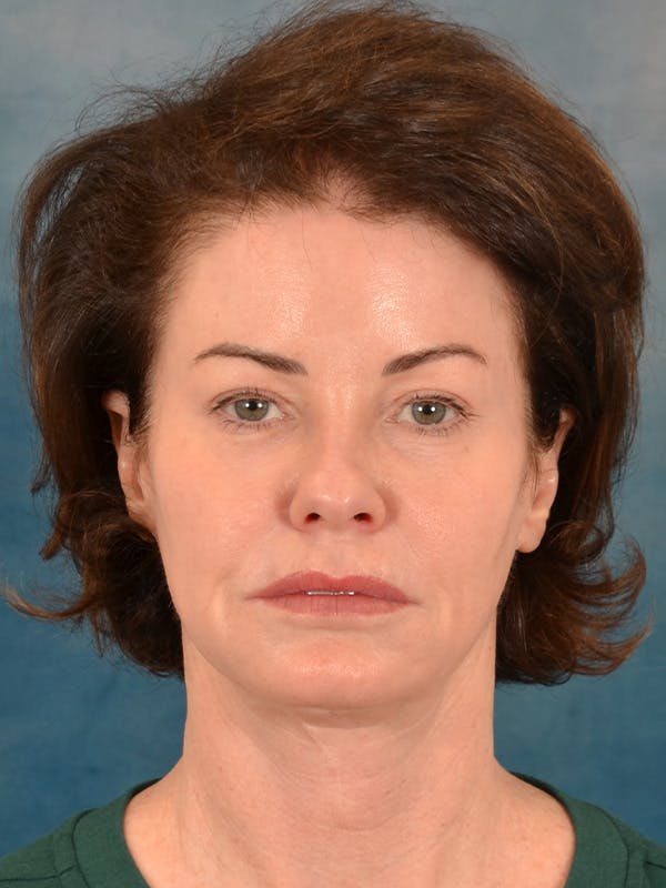 Laser Skin Resurfacing Before & After Gallery - Patient 137244 - Image 1