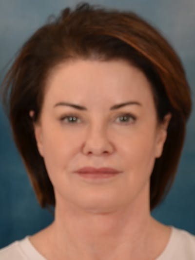 Laser Skin Resurfacing Before & After Gallery - Patient 137244 - Image 2