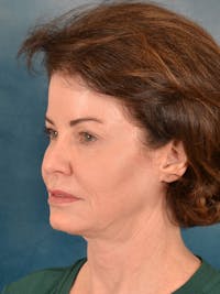 Deep Plane Facelift Before & After Gallery - Patient 297463 - Image 1