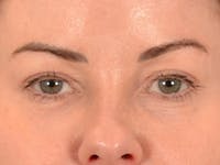 Eyelid Lift Before & After Gallery - Patient 121557 - Image 1