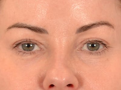 Eyelid Lift Before & After Gallery - Patient 121557 - Image 1