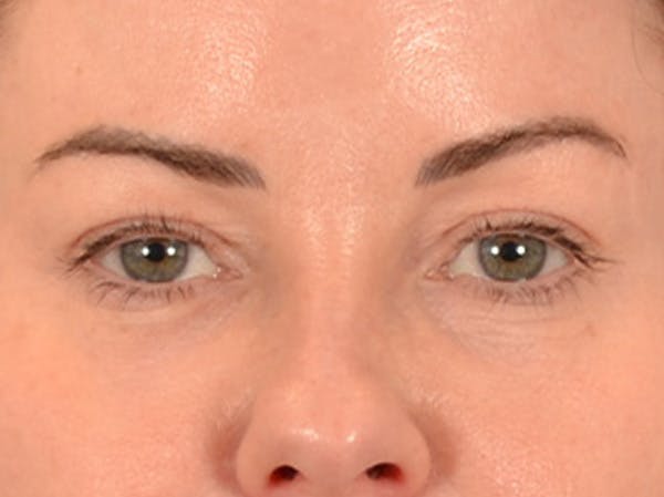 Eyelid Lift Before & After Gallery - Patient 121557 - Image 1