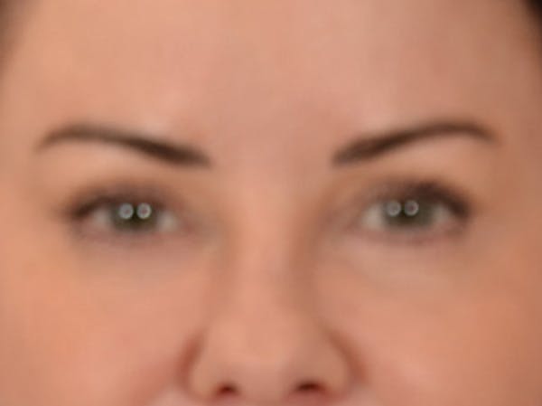 Eyelid Lift Before & After Gallery - Patient 121557 - Image 2
