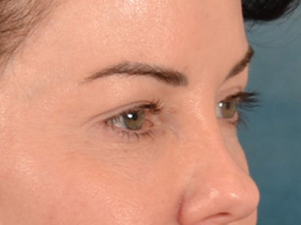 Eyelid Lift Before & After Gallery - Patient 121557 - Image 3