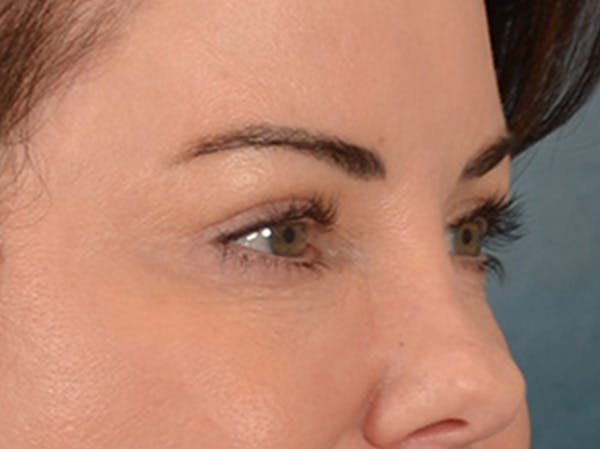 Eyelid Lift Before & After Gallery - Patient 121557 - Image 4