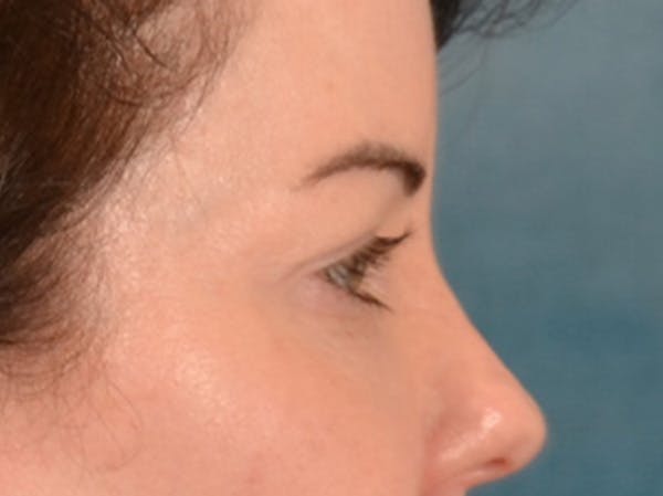 Eyelid Lift Before & After Gallery - Patient 121557 - Image 5