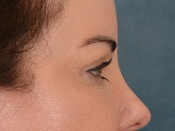 Eyelid Lift Before & After Gallery - Patient 121557 - Image 6
