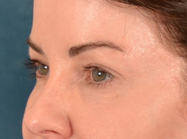 Eyelid Lift Before & After Gallery - Patient 121557 - Image 7