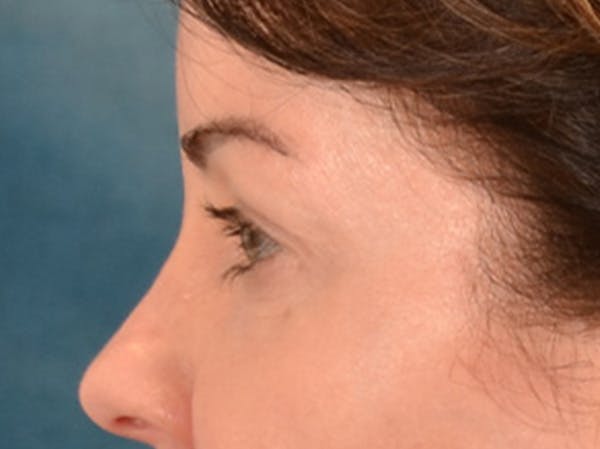 Eyelid Lift Before & After Gallery - Patient 121557 - Image 9