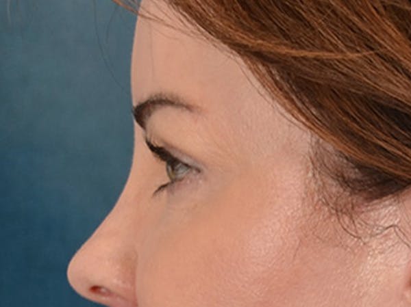 Eyelid Lift Before & After Gallery - Patient 121557 - Image 10