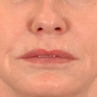 Lip Lift Before & After Gallery - Patient 276256 - Image 1