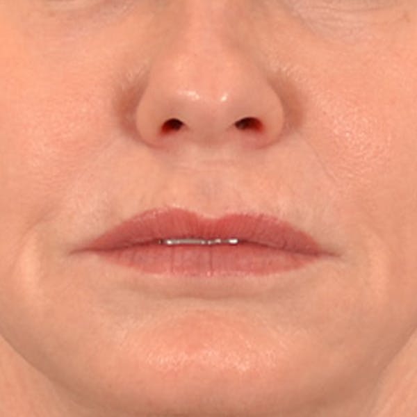 Lip Lift Before & After Gallery - Patient 276256 - Image 1