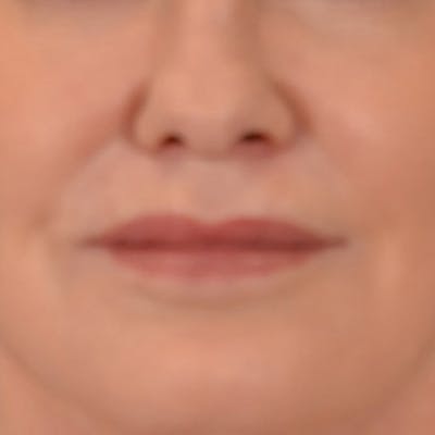 Lip Lift Before & After Gallery - Patient 276256 - Image 2