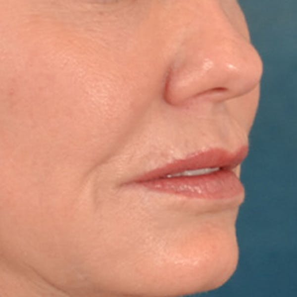 Lip Lift Before & After Gallery - Patient 276256 - Image 3