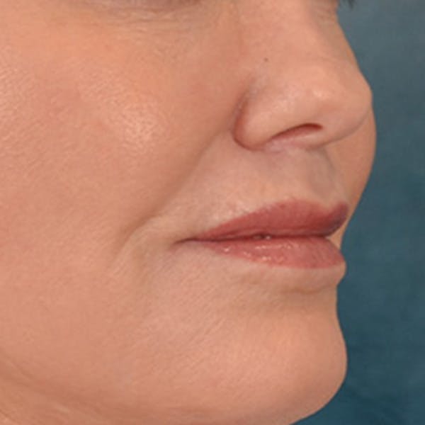Lip Lift Before & After Gallery - Patient 276256 - Image 4
