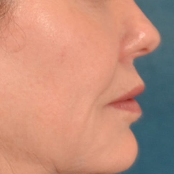 Lip Lift Before & After Gallery - Patient 276256 - Image 5