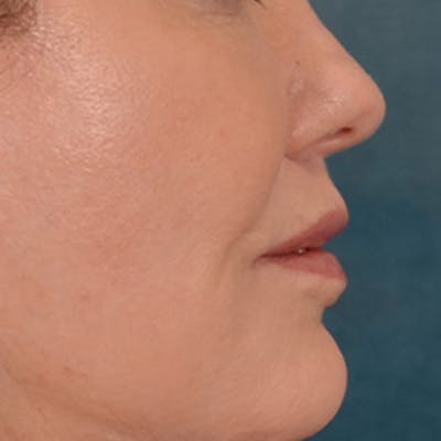 Lip Lift Before & After Gallery - Patient 276256 - Image 6