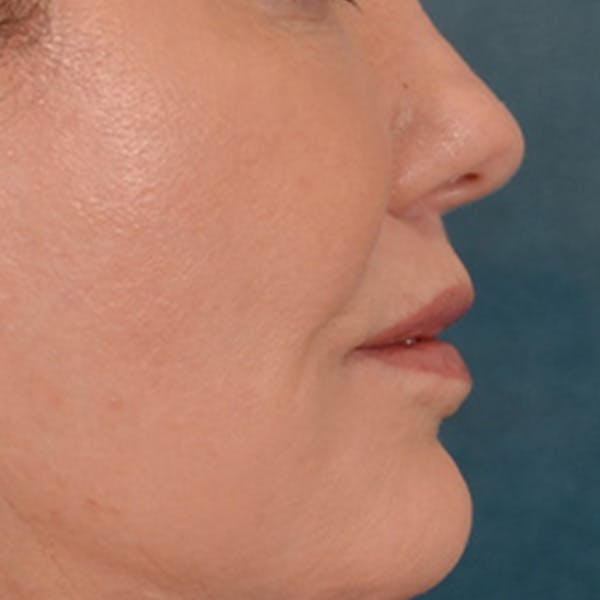 Lip Lift Before & After Gallery - Patient 276256 - Image 6