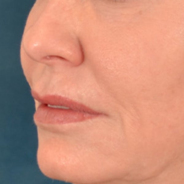 Lip Lift Before & After Gallery - Patient 276256 - Image 7